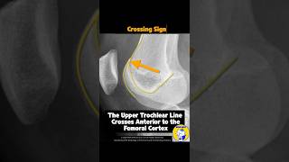 Fig 4A11 Crossing Sign in Trochlear Dysplasia [upl. by Ahsik647]