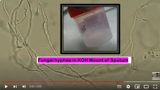 Fungal branched hyphae in KOH mount of Sputum Microscopy [upl. by Africa]