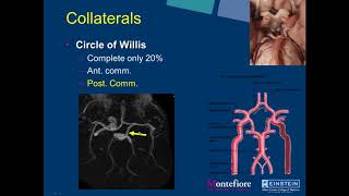 SIRRFS Webinar 2272018 Neuro Interventional Radiology Carotid Artery Stenting [upl. by Anisirhc]