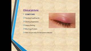 CHALAZION Definition of chalazion  Causes of chalazion✨ [upl. by Shear]