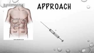 The Therapeutic Paracentesis tricks of the trade [upl. by Woodberry]