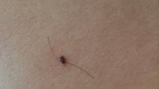 How To Get Rid of Skin Tags Naturally [upl. by Aitnecserc]