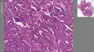 Endometrial Adenocarcinoma  Histopathology [upl. by Rehotsirhc869]