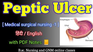 Peptic ulcers bsc nursing 2nd year  Peptic ulcer in hindi  Peptic ulcer medical surgical nursing [upl. by Yznil532]