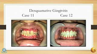 A diagnostic insight of common mucocutaneous lesions II MGMDCH [upl. by Comras430]