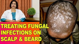 FungalFangal Infections Itching in HeadScalp amp Beard  Treatment  Dr Vijaylaxmi Singh [upl. by Surad]