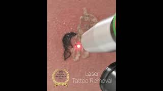 Unicorn Tattoo Art Removal by Revlite Si Laser [upl. by Meedan]