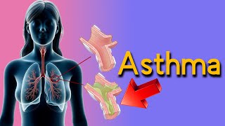 How to Detect Asthma Top 5 Signs and Symptoms asthma causes and treatment [upl. by Mukerji]