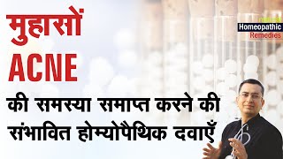 चेहरे पर मुँहासे  Acne  Pimples  Natural Homeopathic remedies  होम्योपैथिक उपचार [upl. by Salazar]