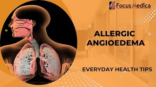 Allergic angioedemaSkin Allergy [upl. by Islaen]