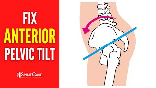 How to Fix Your Anterior Pelvic Tilt  STEPBYSTEP Guide [upl. by Namzzaj]