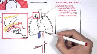 Lung Carcinoma Lung cancer [upl. by Ennis]