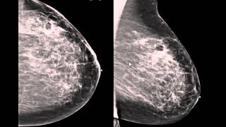 Digital Breast Tomosynthesis Occult radial scar ILC in fatty breast tissue [upl. by Merilyn]