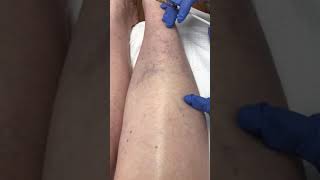 Sclerotherapy leg vein treatment with Asclera [upl. by Aivlis126]