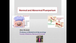 Normal and Abnormal Puerperium [upl. by Desdamona999]