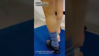 Prosthetics for Limb Length difference Anomalies orthoticsandprostheticslimblengthening [upl. by Ehctav]