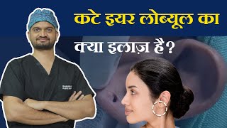 कटे इयर लोब्यूल का क्या इलाज़ है  Treatment for Ear Lobule cut  Explained by Dr Aakansh [upl. by Anehsuc]