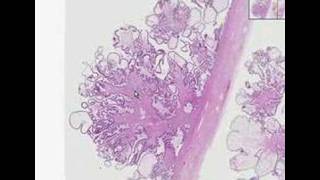 Histopathology OvarySerous cystadenoma [upl. by Don]