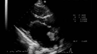 MS different aspectsmitral stenosis with LA thrombus [upl. by Nnylekoorb31]