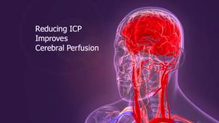 IPR Therapy Overview [upl. by Wilkins]