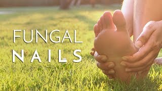 Principal Podiatrist Michael Lai Explains What Causes Fungal Toenails [upl. by Nova]