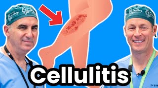 Cellulitis Explained By Infectious Disease Doc Red Sore And Swollen [upl. by Pretrice]