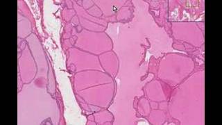 Histopathology ThyroidColloid goiter [upl. by Nauht]