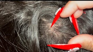 Satisfying Hard crunchy dandruff  psoriasis scalp scratching Asmr with Nails [upl. by Aicilef]