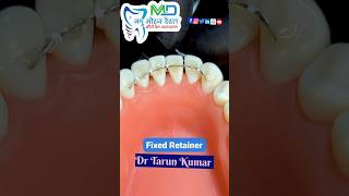 Fixed retainer fixed retainer viralvideo shorts dentalclinic orthodontist [upl. by Thorin]