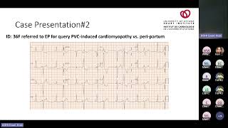 Frequent Ventricular Ectopy Defining Outcomes When and How to Treat with Michael Thibert MD [upl. by Noli]