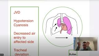 Tension Pneumothorax Pathophysiology Etiology and Treatment in the Prehospital Setting [upl. by Kimbell]