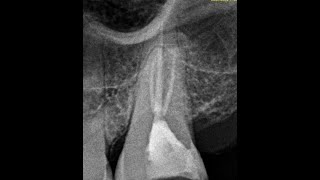 A day with second molars [upl. by Caiaphas661]