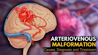 Arteriovenous Malformation Causes Signs and Symptoms Diagnosis and Treatment [upl. by Dicky]