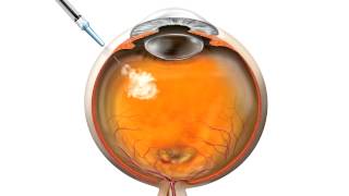 Anti VEGF Injection for macular degeneration [upl. by Anitsihc]