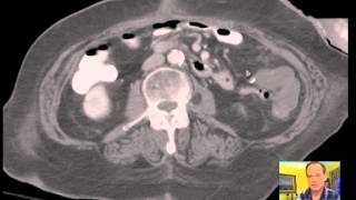 CT Abdomen and Pelvis BLOOD VESSELS  Vascular Anatomy Discussion [upl. by Yenrab327]