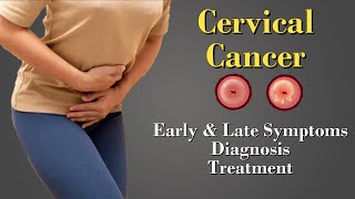 Cervical Cancer  HPV  Causes  Symptoms  Staging amp Treatment [upl. by Aknahs93]