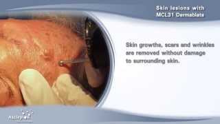 Removal of skin lesions with the MCL31 Dermablate erbium laser by Asclepion [upl. by Ominoreg]