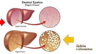 Steatosi Epatica fegato grasso come si previene come si combatte [upl. by Lorri]