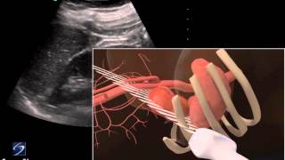 3D How To Left Kidney Ultrasound  SonoSite Ultrasound [upl. by Eveivaneg236]