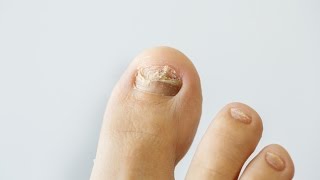 How to prevent and treat nail fungus [upl. by Relyuhcs610]