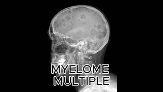 MYELOME MULTIPLE OU MALADIE DE KHALER [upl. by Margarita]