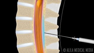 Lumbar Epidural Steroid Injection Animation [upl. by Mccollum235]