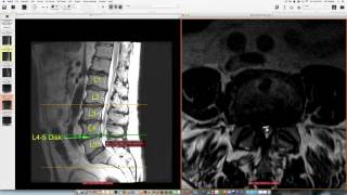 MRI scan of the lumbar spine [upl. by Lleihsad]