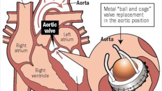 Pyrolytic Carbon Heart Valves  Graphene MCV [upl. by Apicella320]