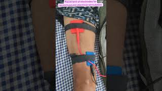 Placement of electrode for neuromuscular electrical muscle stimulation for ms reeducationshorts [upl. by Benildis]