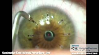 Conductive Keratoplasty Procedure  live [upl. by Adnirual]