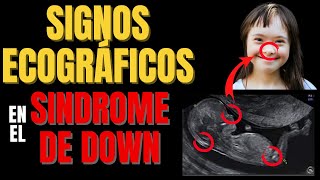 🔴SIGNOS ECOGRÁFICOS TÍPICOS EN EL SÍNDROME DE DOWN🚼DIAGNOSIS OF DOWN SYNDROME ULTRASOUND FINDINGS [upl. by Davin]