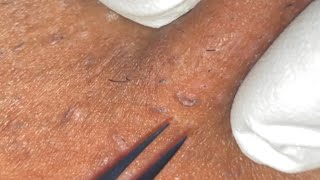 Ingrown Hair Removal Ep29 [upl. by Jerrol]