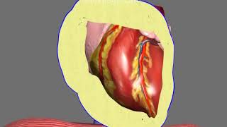 Pericardiocentesis in Pericardial Effusion and Cardiac Tamponade Animation by Cal Shipley MD [upl. by Herculie]