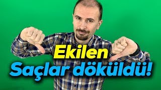 Ekilen saçlar döküldü  7 hafta geride kaldı PRP yaptırdım [upl. by Germin]